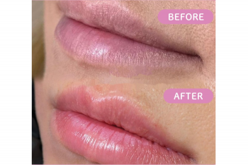 公式から唇のbefore after