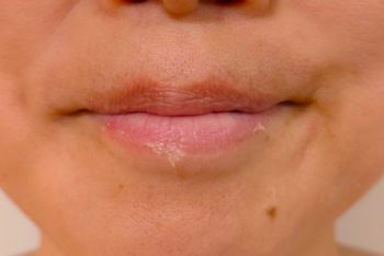 １日後の皮がめくれてきた状態